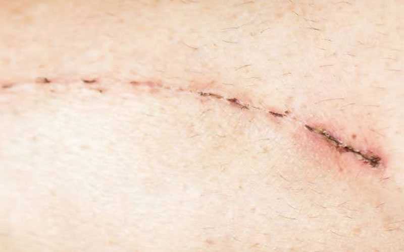 bypas surgery