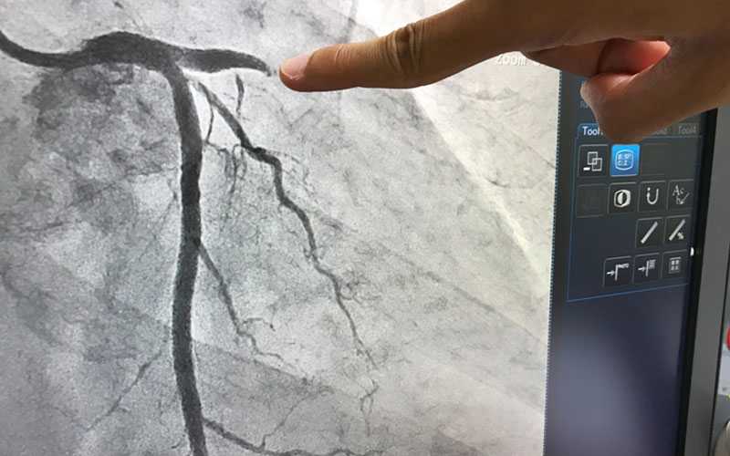 coronary angiogram