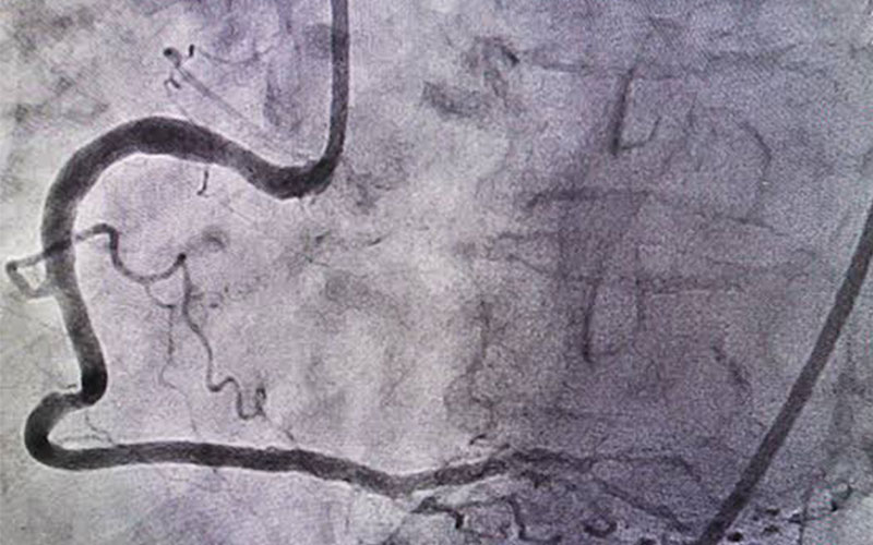 ct.angiogram