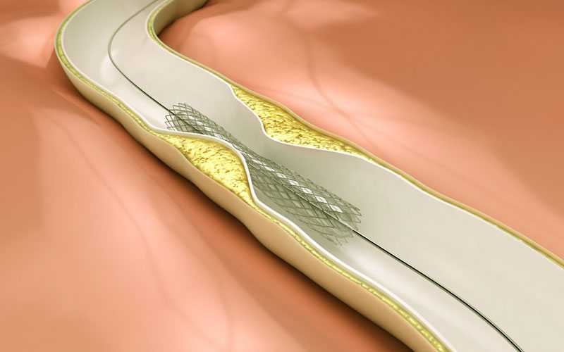 dyslipidemia
