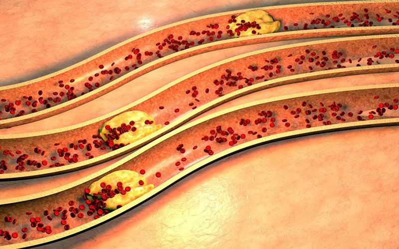 hypercholesterolemia treatment